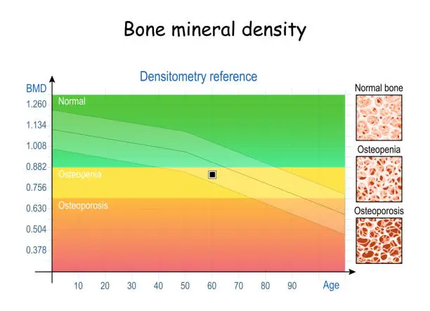 Bone Mineral Density Test