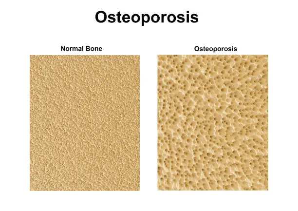 Bone test